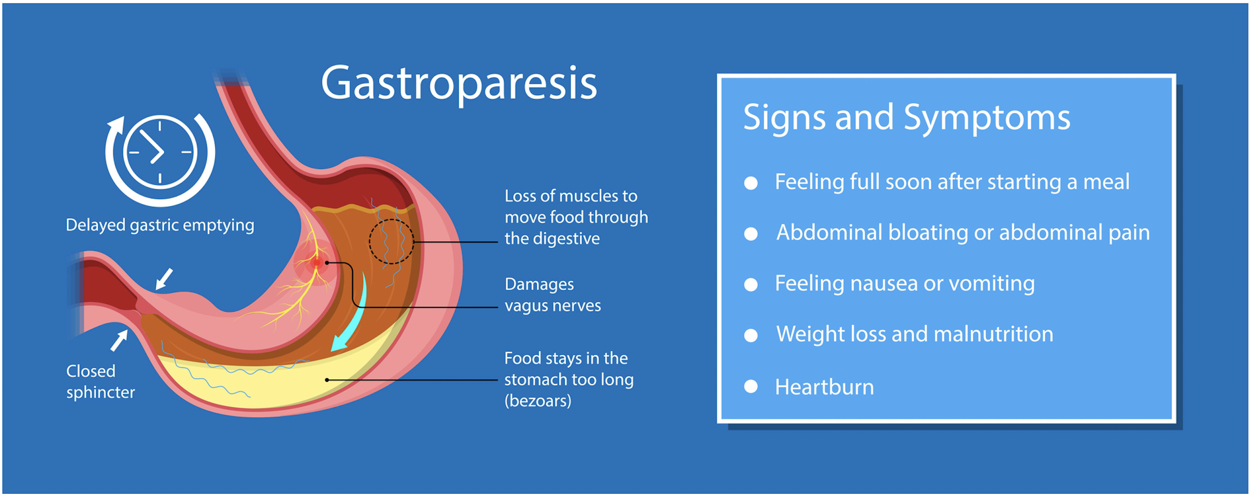 How To Treat Gastroparesis Without Medication